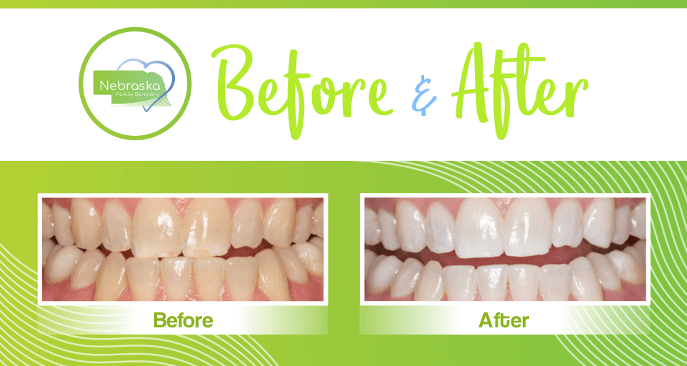 When Can I Drink After White Strips?
